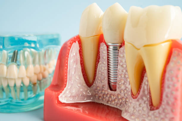 Best Dental Fillings (Composite and Amalgam)  in Montecito, CA